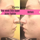 Super Acne Fighter / Organic Acne Treatment